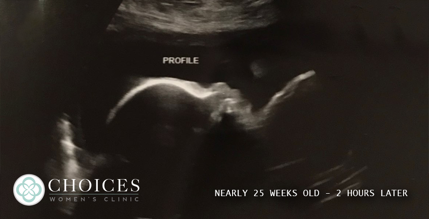 Choices Women's Clinic version of a 25 weeks old 'fetus'