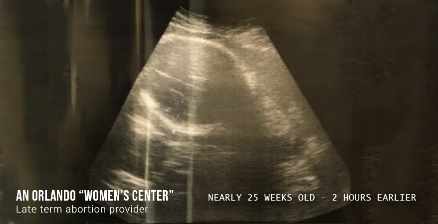 Abortion Clinic's version of a 25 weeks old 'fetus'